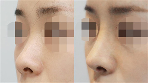 为什么有些人做完鼻小柱延长像猪鼻子?