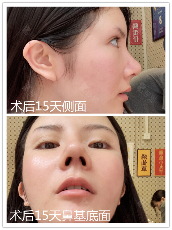 隆鼻感染的症状有哪些